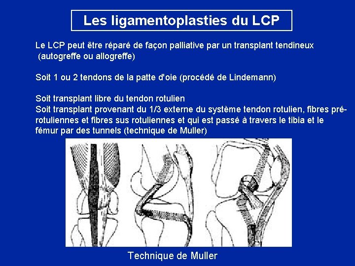 Les ligamentoplasties du LCP Le LCP peut être réparé de façon palliative par un