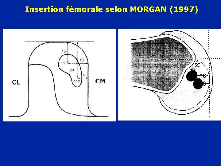 Insertion fémorale selon MORGAN (1997) (mm) 