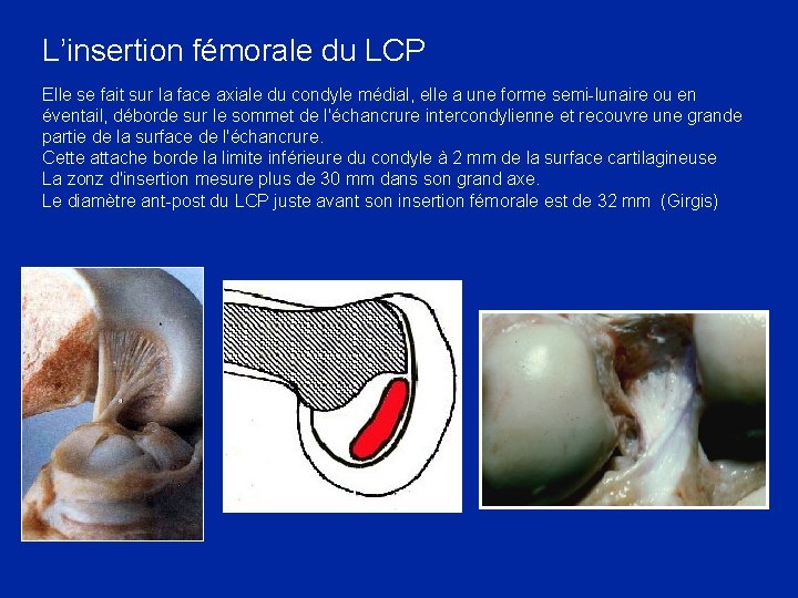 L’insertion fémorale du LCP Elle se fait sur la face axiale du condyle médial,