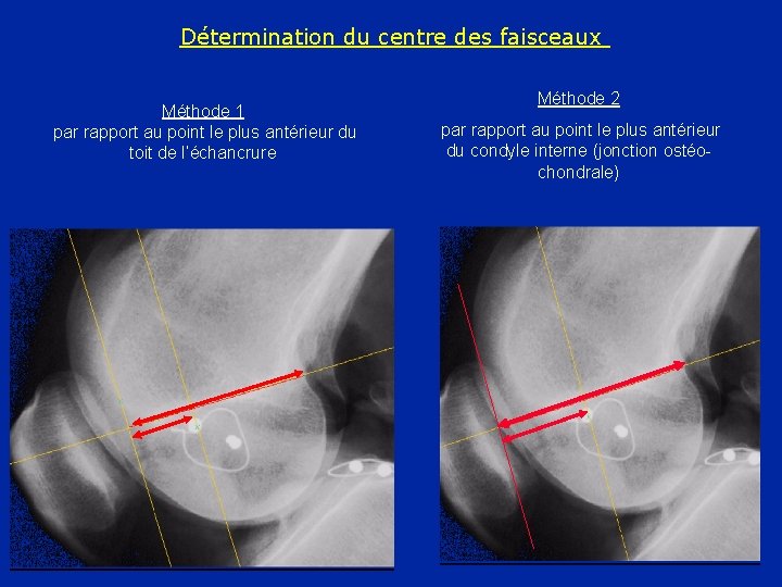 Détermination du centre des faisceaux Méthode 1 par rapport au point le plus antérieur