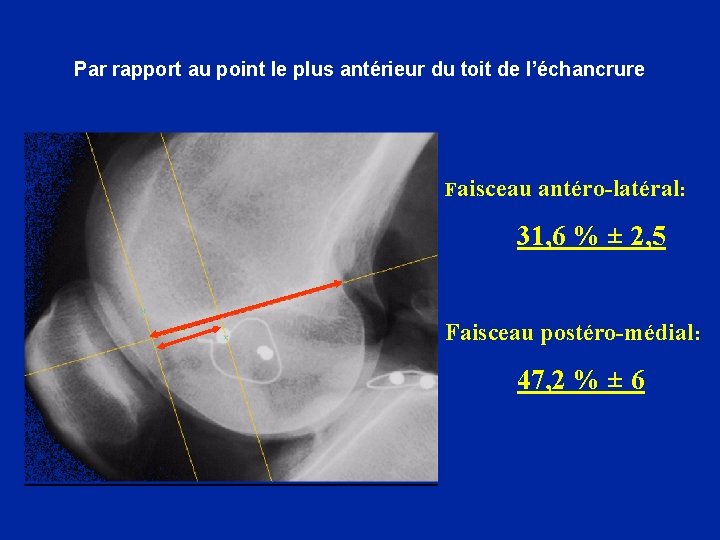  Par rapport au point le plus antérieur du toit de l’échancrure Faisceau antéro-latéral: