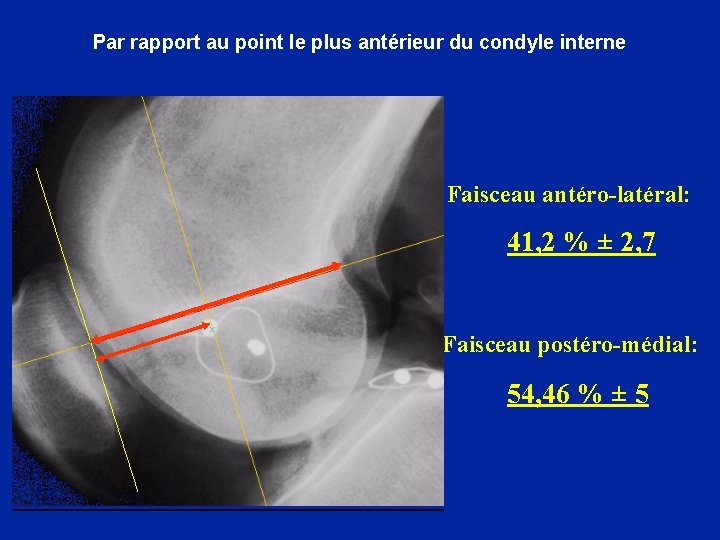 Par rapport au point le plus antérieur du condyle interne - Faisceau antéro-latéral: 41,