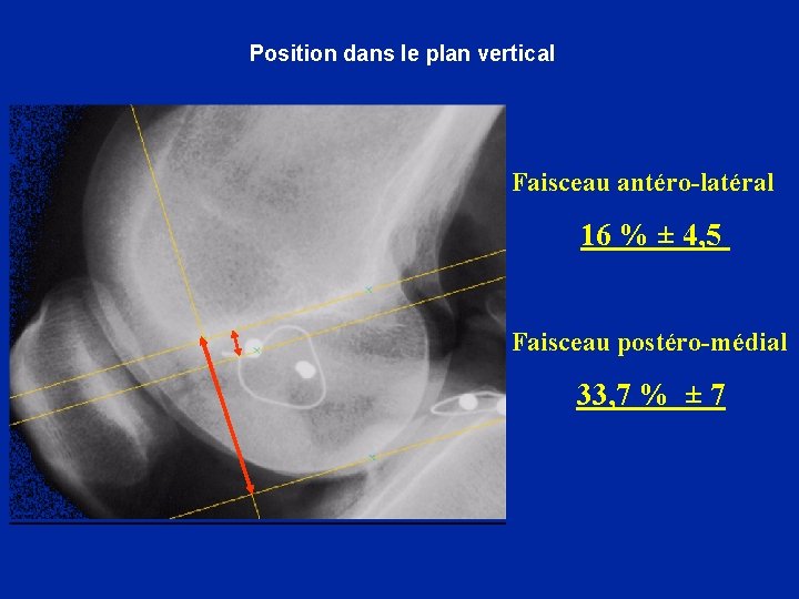  Position dans le plan vertical Faisceau antéro-latéral 16 % ± 4, 5 Faisceau