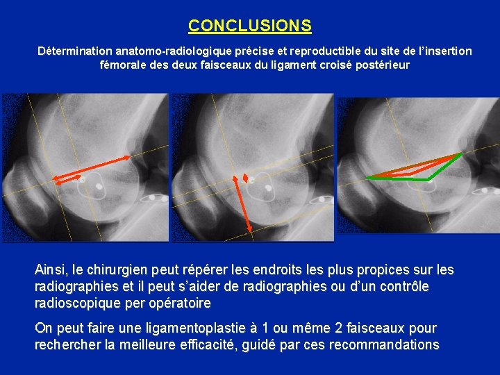 CONCLUSIONS Détermination anatomo-radiologique précise et reproductible du site de l’insertion fémorale des deux faisceaux