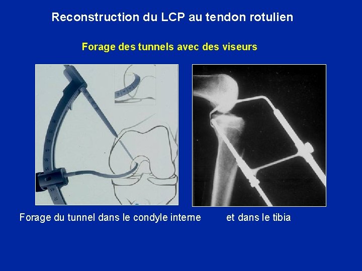 Reconstruction du LCP au tendon rotulien Forage des tunnels avec des viseurs Forage du