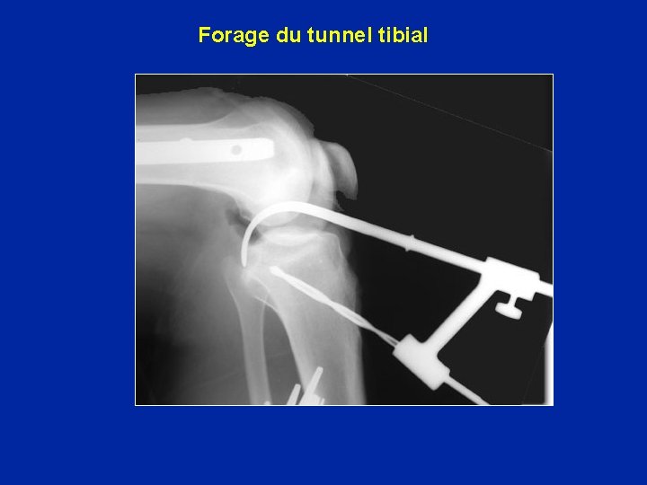 Forage du tunnel tibial 