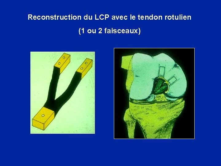Reconstruction du LCP avec le tendon rotulien (1 ou 2 faisceaux) 
