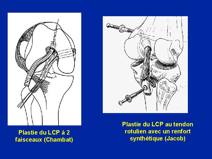 Plastie du LCP à 2 faisceaux (Chambat) Plastie du LCP au tendon rotulien avec