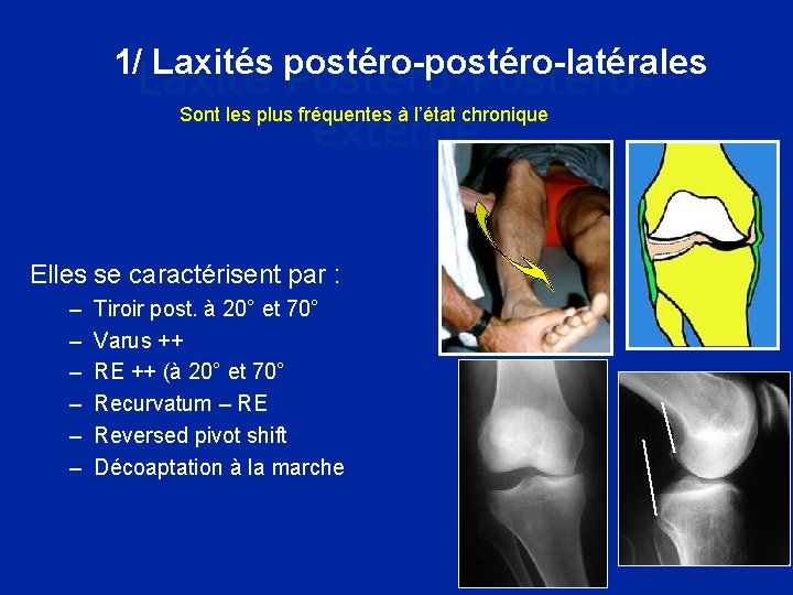  1/ Laxités postéro-latérales Laxité Postéro-Postéro. Sont les plus fréquentes à l’état chronique externe