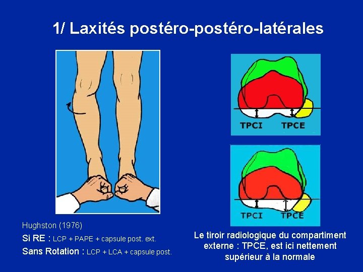  1/ Laxités postéro-latérales Hughston (1976) Si RE : LCP + PAPE + capsule