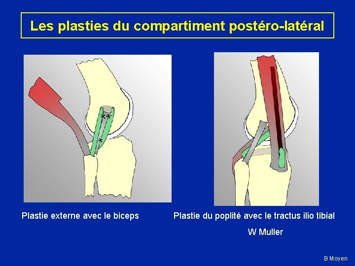Les plasties du compartiment postéro-latéral Plastie externe avec le biceps Plastie du poplité avec