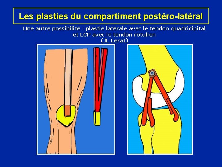 Les plasties du compartiment postéro-latéral Une autre possibilité : plastie latérale avec le tendon