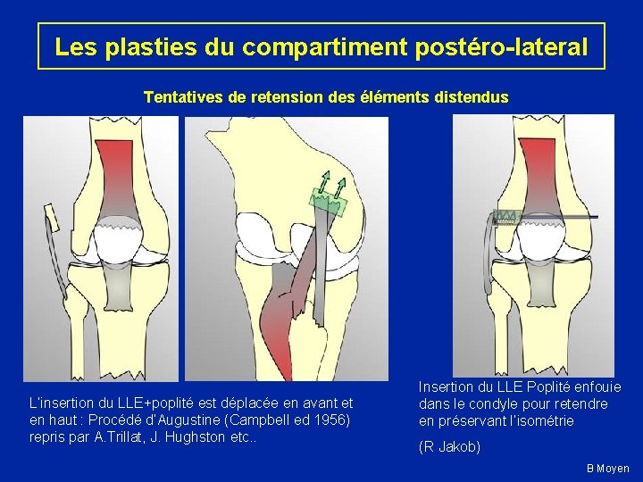 Les plasties du compartiment postéro-lateral Tentatives de retension des éléments distendus L’insertion du LLE+poplité
