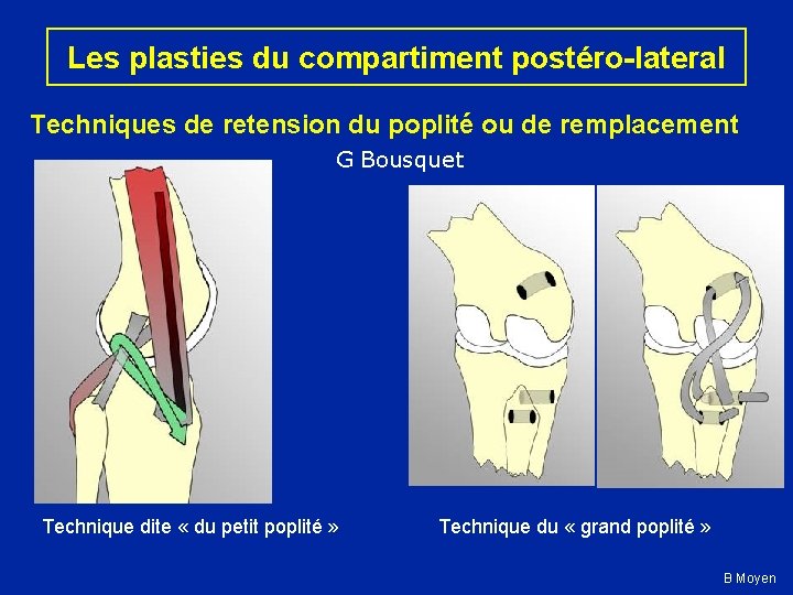 Les plasties du compartiment postéro-lateral Techniques de retension du poplité ou de remplacement G