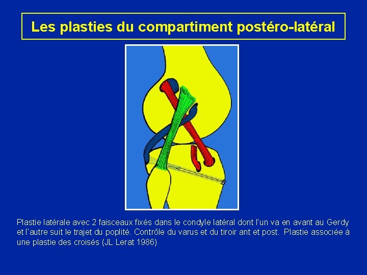 Les plasties du compartiment postéro-latéral Plastie latérale avec 2 faisceaux fixés dans le condyle