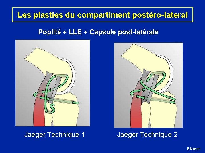 Les plasties du compartiment postéro-lateral Poplité + LLE + Capsule post-latérale Jaeger Technique 1