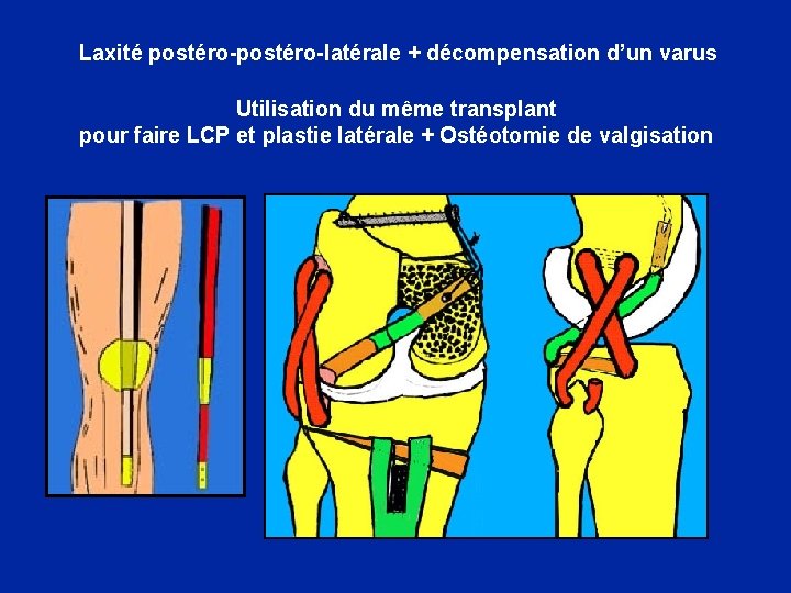 Laxité postéro-latérale + décompensation d’un varus Utilisation du même transplant pour faire LCP et