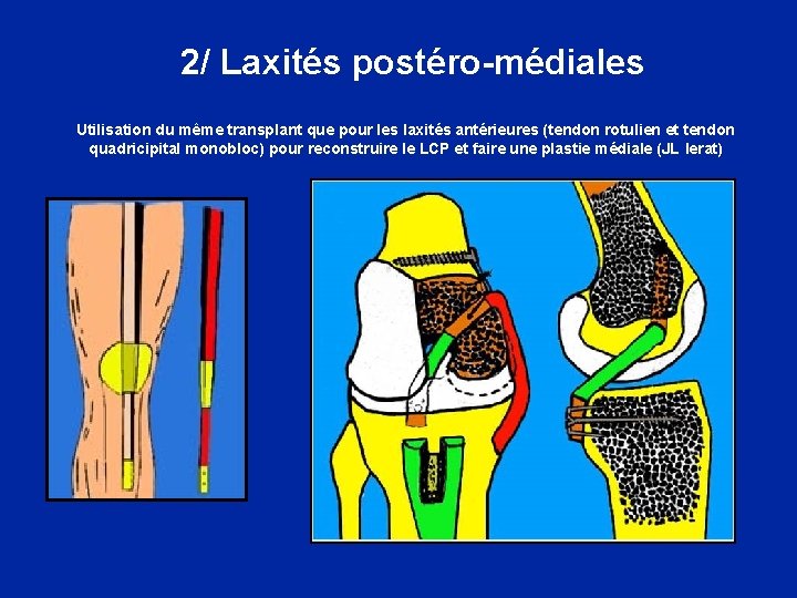  2/ Laxités postéro-médiales Utilisation du même transplant que pour les laxités antérieures (tendon
