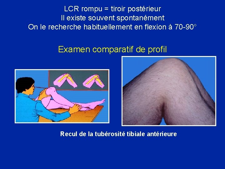 LCR rompu = tiroir postérieur Il existe souvent spontanément On le recherche habituellement en