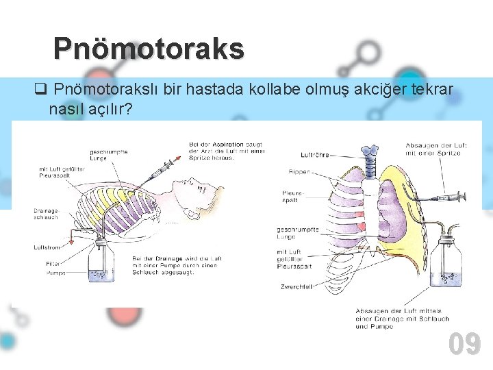 02 Pnömotoraks q Pnömotorakslı bir hastada kollabe olmuş akciğer tekrar nasıl açılır? 09 