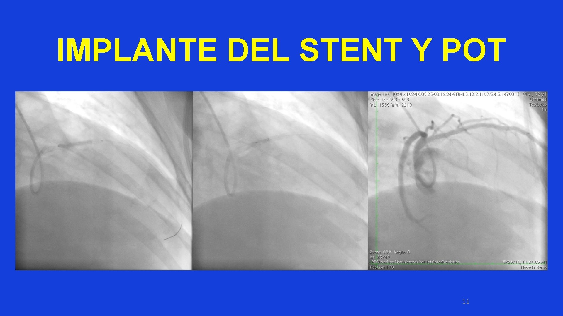 IMPLANTE DEL STENT Y POT 11 