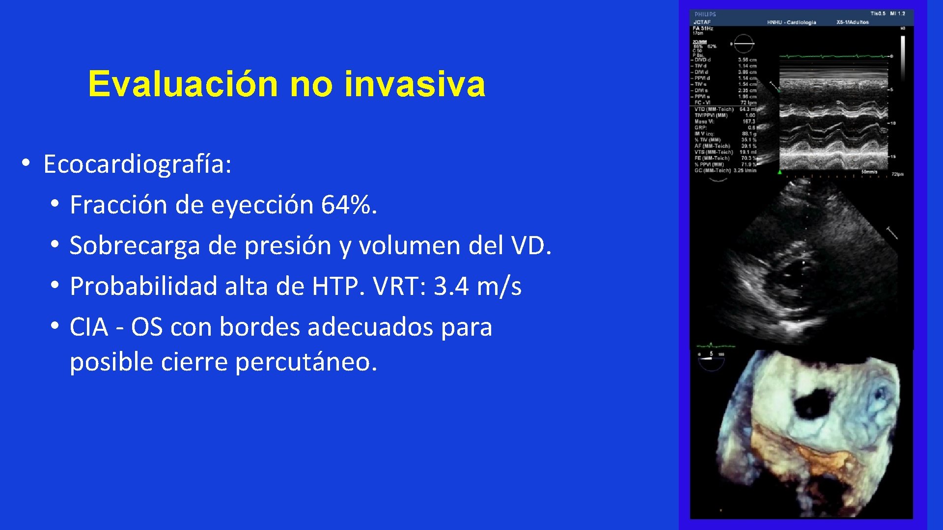 Evaluación no invasiva • Ecocardiografía: • Fracción de eyección 64%. • Sobrecarga de presión
