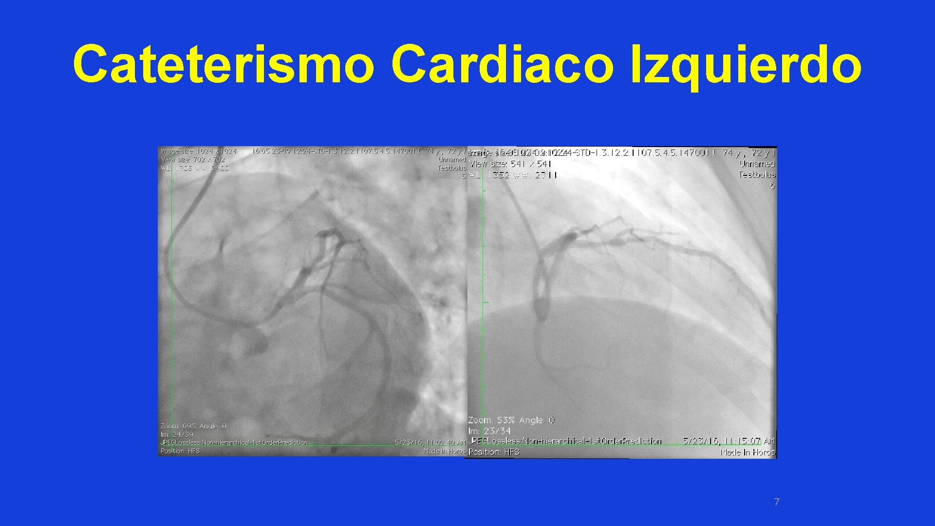 Cateterismo Cardiaco Izquierdo 7 