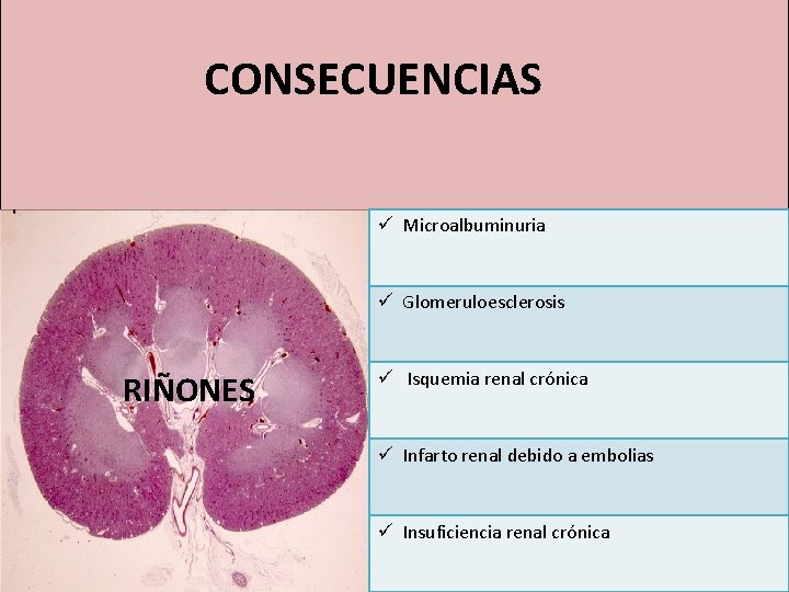 CONSECUENCIAS ü Microalbuminuria ü Glomeruloesclerosis RIÑONES ü Isquemia renal crónica ü Infarto renal debido