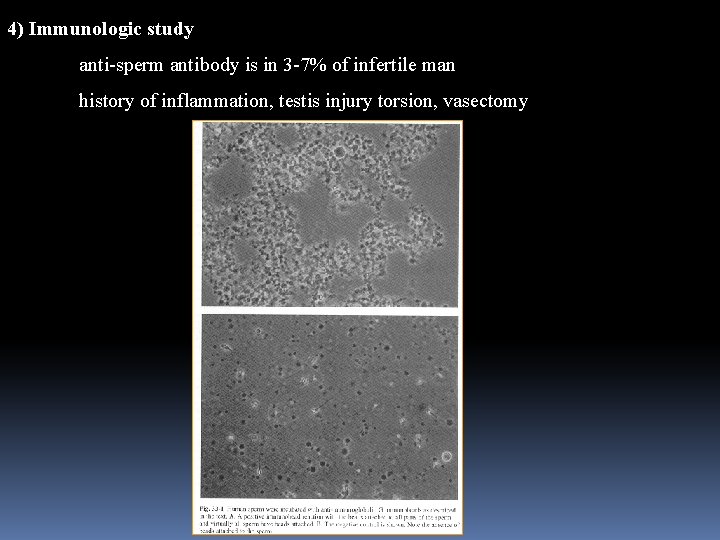 4) Immunologic study anti-sperm antibody is in 3 -7% of infertile man history of