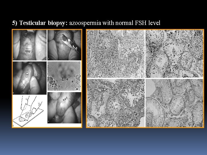  5) Testicular biopsy: azoospermia with normal FSH level 