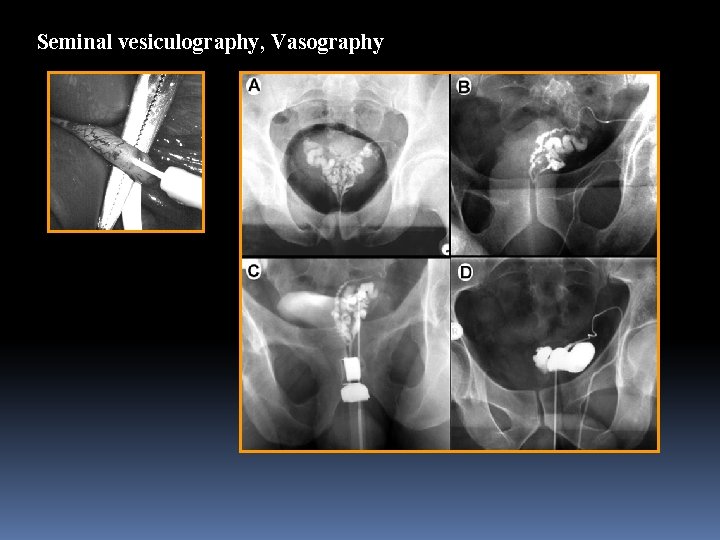 Seminal vesiculography, Vasography 