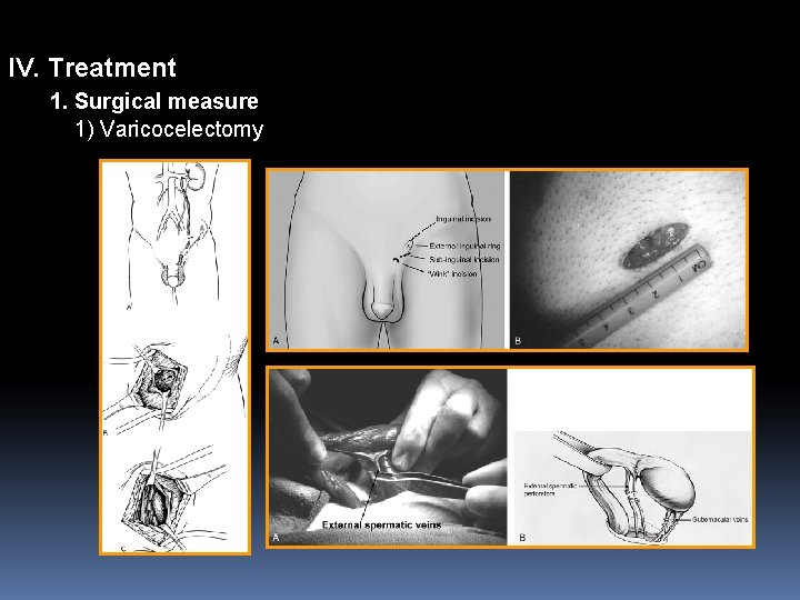 IV. Treatment 1. Surgical measure 1) Varicocelectomy 