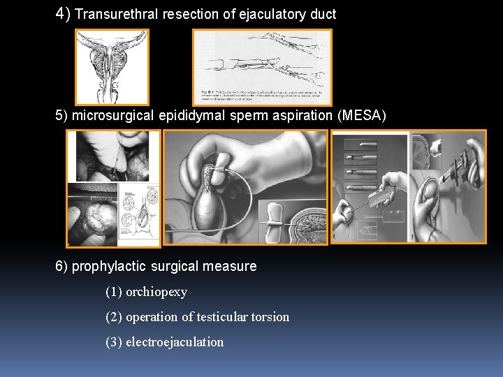 4) Transurethral resection of ejaculatory duct 5) microsurgical epididymal sperm aspiration (MESA) 6) prophylactic