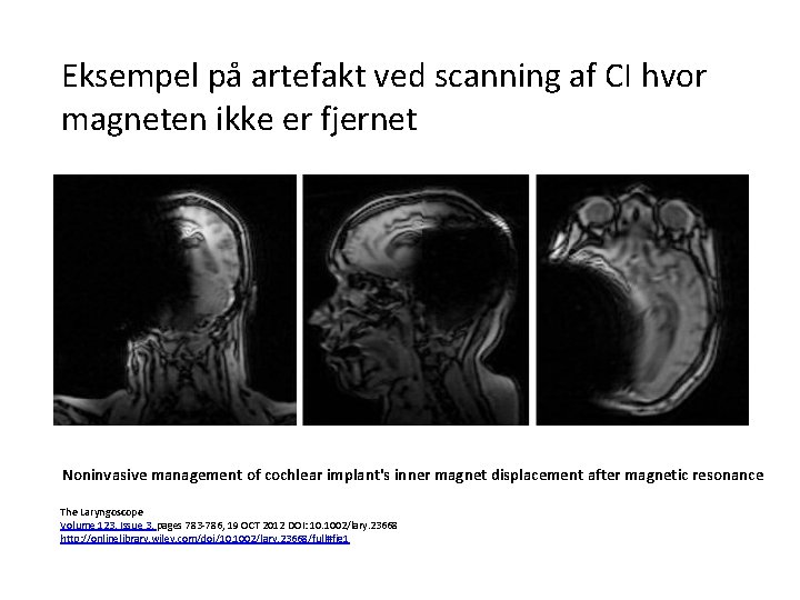 Eksempel på artefakt ved scanning af CI hvor magneten ikke er fjernet Noninvasive management