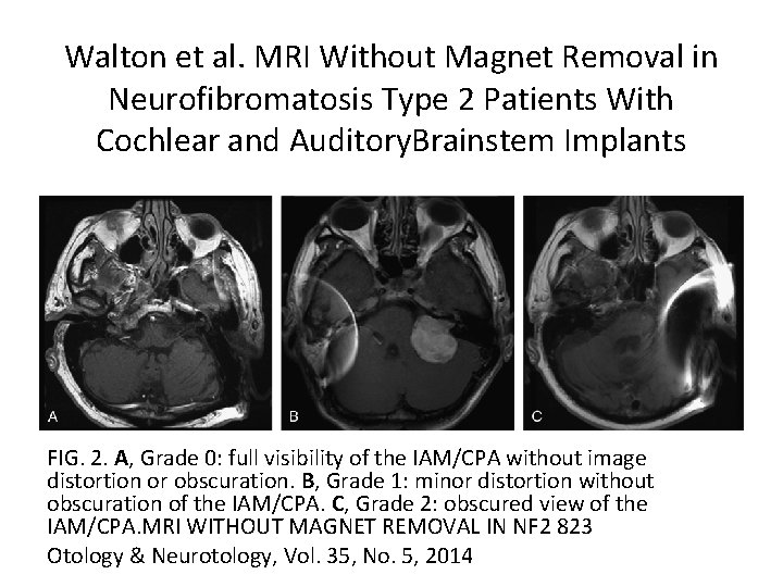 Walton et al. MRI Without Magnet Removal in Neurofibromatosis Type 2 Patients With Cochlear