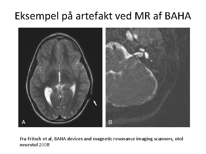 Eksempel på artefakt ved MR af BAHA Fra Fritsch et al, BAHA devices and