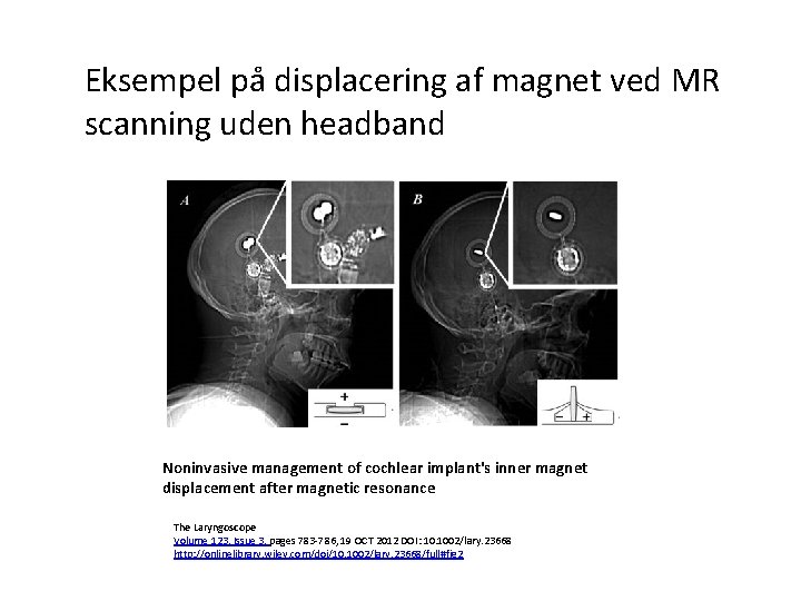 Eksempel på displacering af magnet ved MR scanning uden headband Noninvasive management of cochlear
