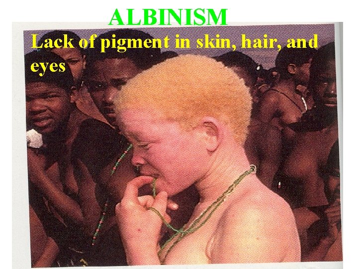 ALBINISM Lack of pigment in skin, hair, and eyes 