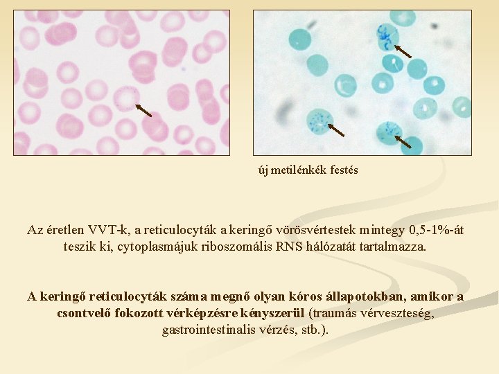 új metilénkék festés Az éretlen VVT-k, a reticulocyták a keringő vörösvértestek mintegy 0, 5