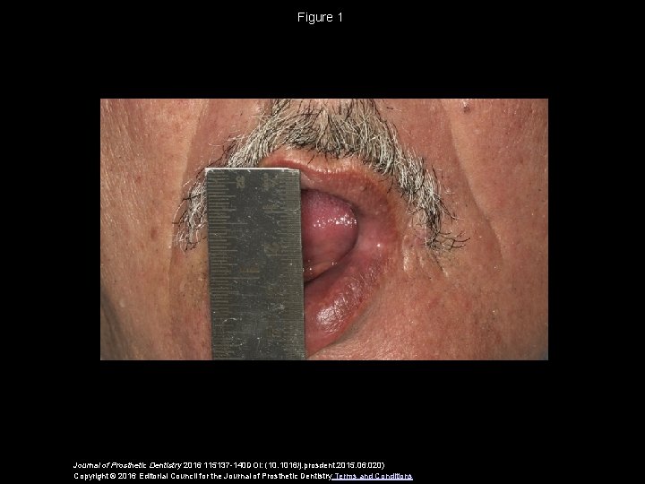 Figure 1 Journal of Prosthetic Dentistry 2016 115137 -140 DOI: (10. 1016/j. prosdent. 2015.