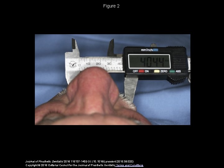 Figure 2 Journal of Prosthetic Dentistry 2016 115137 -140 DOI: (10. 1016/j. prosdent. 2015.