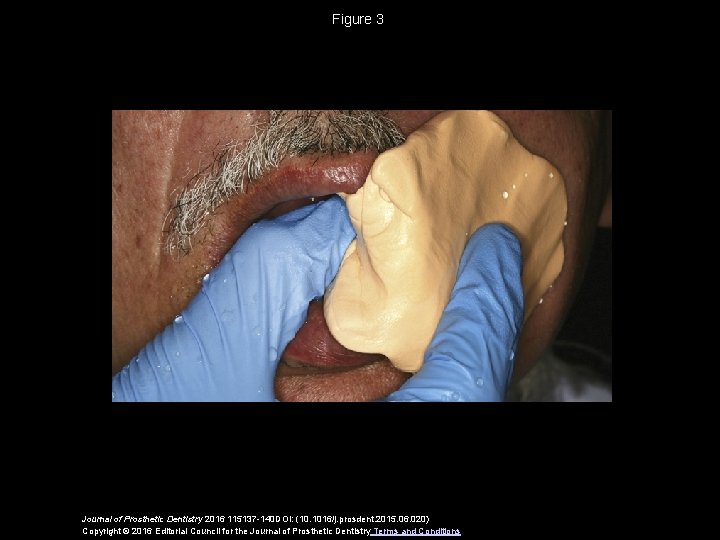 Figure 3 Journal of Prosthetic Dentistry 2016 115137 -140 DOI: (10. 1016/j. prosdent. 2015.