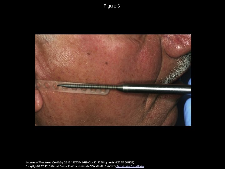 Figure 6 Journal of Prosthetic Dentistry 2016 115137 -140 DOI: (10. 1016/j. prosdent. 2015.