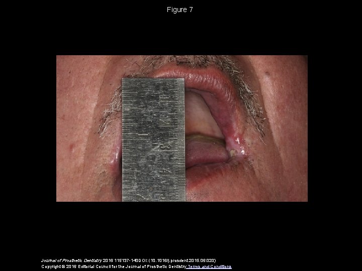 Figure 7 Journal of Prosthetic Dentistry 2016 115137 -140 DOI: (10. 1016/j. prosdent. 2015.