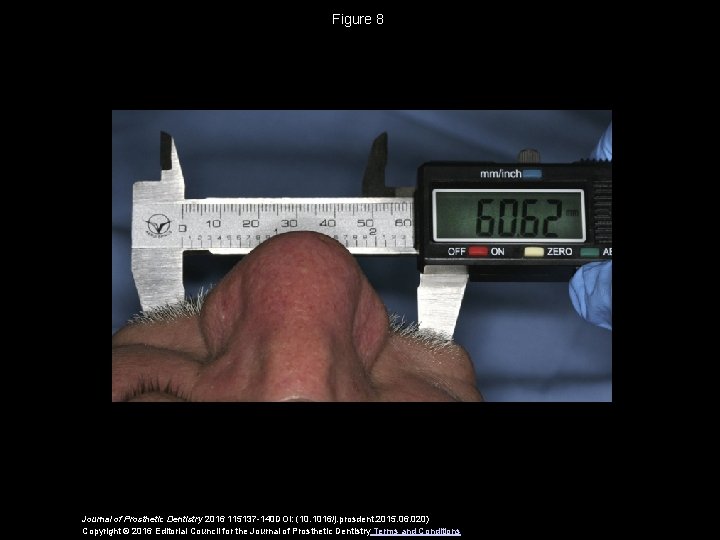 Figure 8 Journal of Prosthetic Dentistry 2016 115137 -140 DOI: (10. 1016/j. prosdent. 2015.