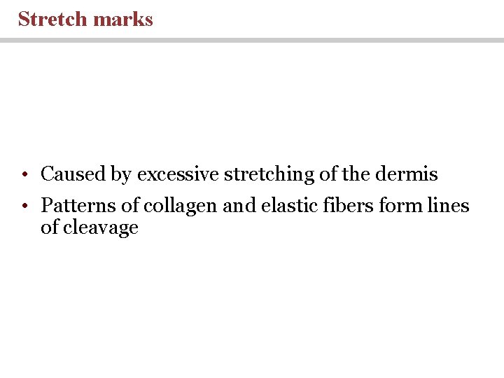 Stretch marks • Caused by excessive stretching of the dermis • Patterns of collagen