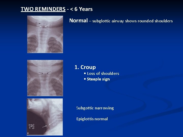 TWO REMINDERS - < 6 Years Normal – subglottic airway shows rounded shoulders 1.