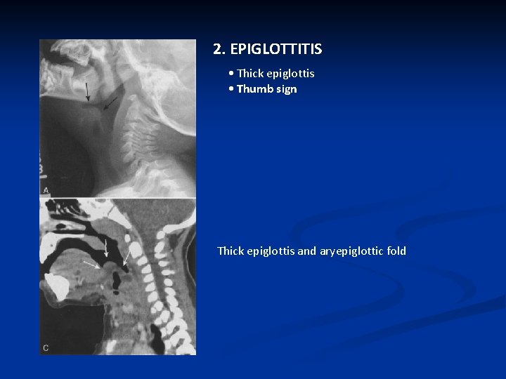 2. EPIGLOTTITIS • Thick epiglottis • Thumb sign Thick epiglottis and aryepiglottic fold 