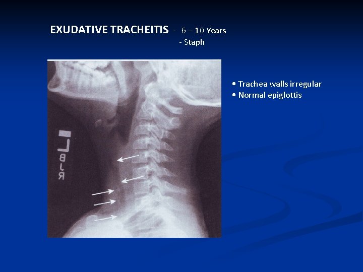 EXUDATIVE TRACHEITIS - 6 – 10 Years - Staph • Trachea walls irregular •