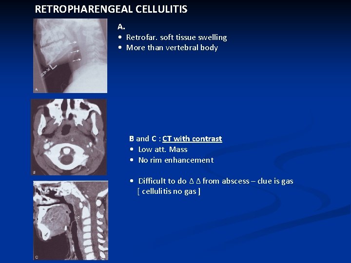 RETROPHARENGEAL CELLULITIS A. • Retrofar. soft tissue swelling • More than vertebral body B